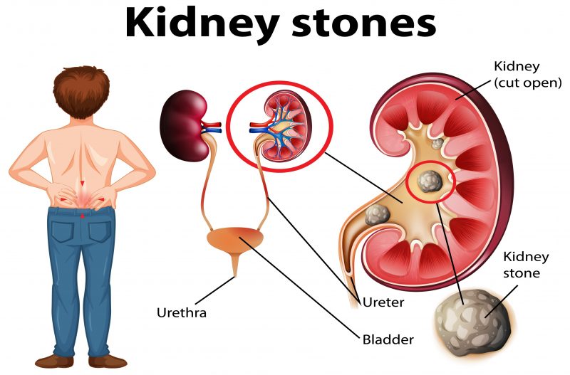 Moringa for kidney stones 
